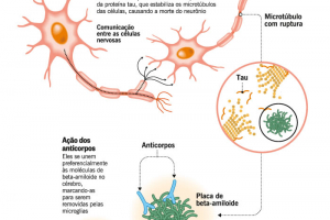 Droga em teste elimina as placas no cérebro que causam Alzheimer